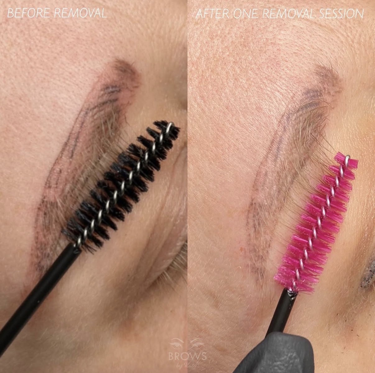 Brow tattoo removal one session result Royal Palm Beach FL